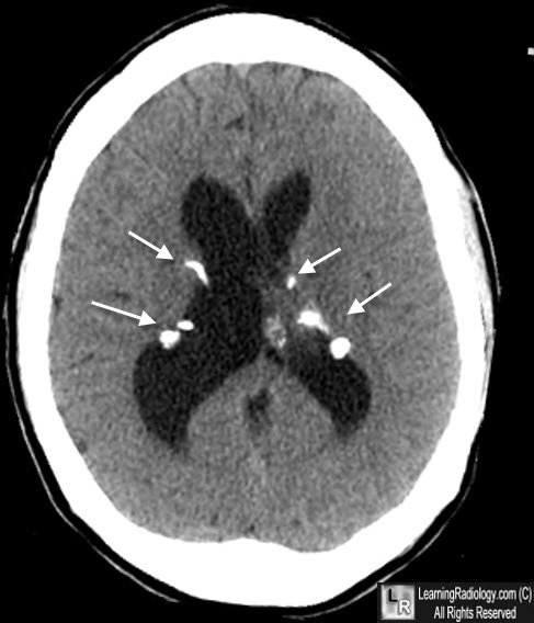 Tuberous Sclerosis